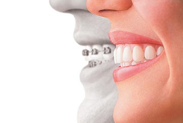 Get Your Invisalign Clear Braces at Our Ideal Smile Philadelphia